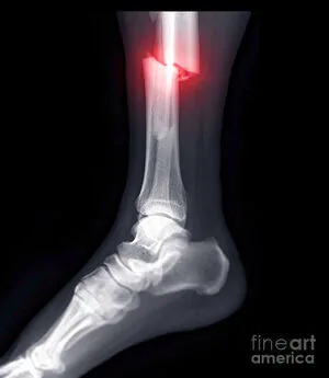 Brokenleg OnlyFans Leaked Free Thumbnail Picture - #tPfTWDdFce