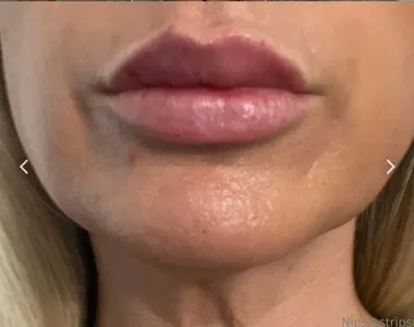 Nipsstrips Thumbnail Picture