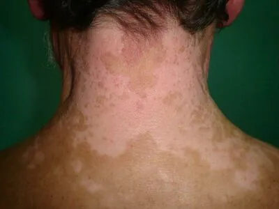 Vitiligo OnlyFans Leaked Free Thumbnail Picture - #L6kWlicI8H