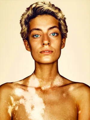 Vitiligo OnlyFans Leaked Free Thumbnail Picture - #mOETJziZOR